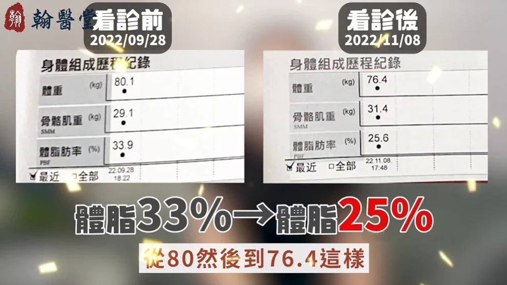 送自己的30歲大禮！陳信宏中醫師埋線減重成功案例，成功甩掉多年肥肉，體脂狂降8%！