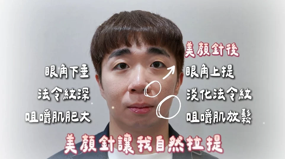 睡不好疲憊顯老？蔡侑熹中醫師「美顏針」素人實測，朋友都驚呼變年輕！